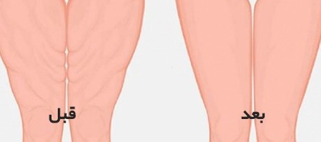 شفط الدهون والليبوماتيك في إيران